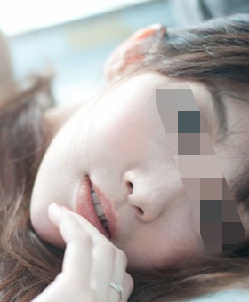 切开双眼皮修复